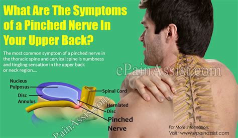 Exercises For Pinched Nerve In Neck And Upper Back Exercise Poster