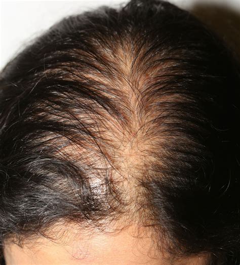 Thyroid And Hair Loss Galhairs