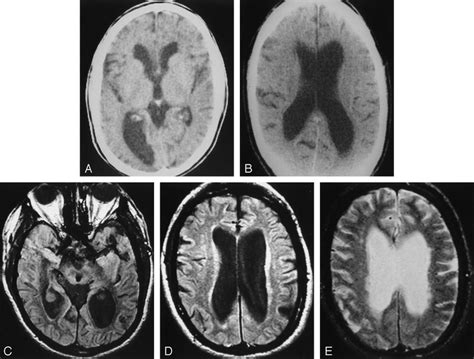 Chronically Enlarged Ventricles In A Patient Developing Nph A At Age