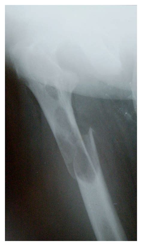 Radiographs Of Pathological Subtrochanteric Fracture Of Right Femur