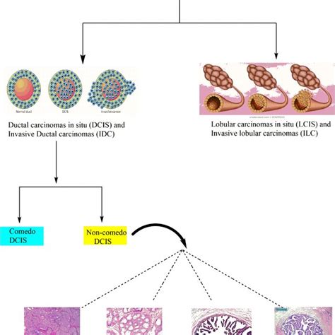 Pathophysiology Of Breast Cancer Download Scientific Diagram