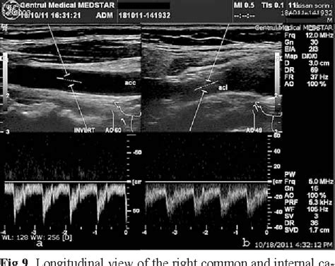 Doppler Ultrasound Scan Of Carotid Artery Stenosis Stock Image M My