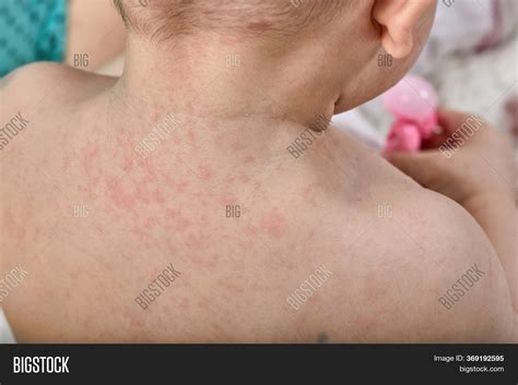 Roseola Rash Viral Image And Photo Free Trial Bigstock