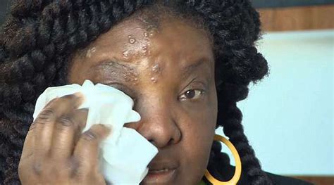 Black Woman Kicked Off Air Canada Flight Over Rash On Her Face Daily