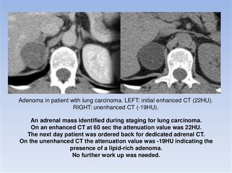 Adrenal Gland Tumors Radiology