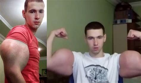 Man Injecting His Biceps With Homemade Muscle Builder Might Lose His