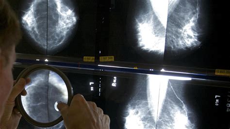 us requires new info on breast density with all mammograms ap news