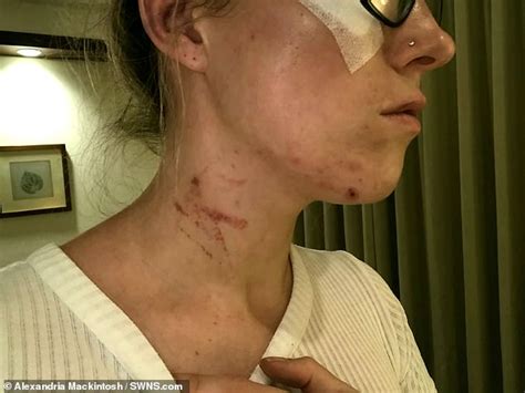 British Backpacker 26 Scarred For Life After Attack By Two Female