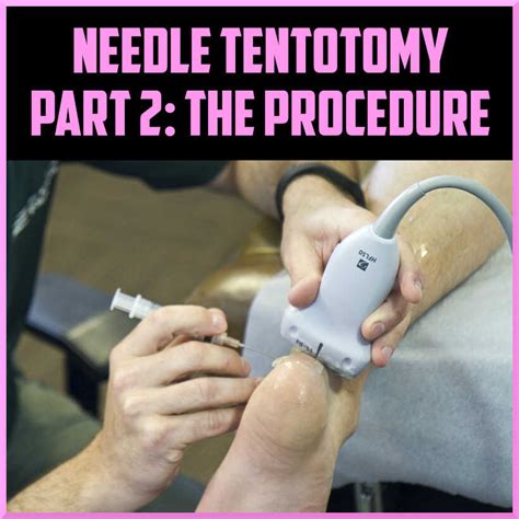 Percutaneous Ultrasound Guided Tenotomy Part 2 Sports Medicine Review