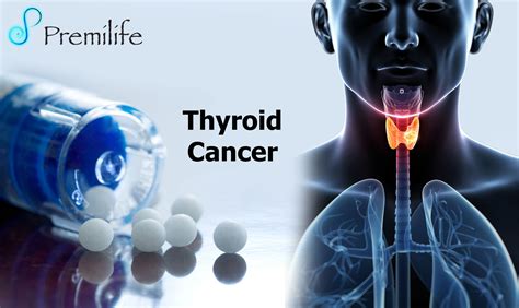 Thyroid Cancer Premilife Homeopathic Remedies