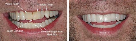 Not all conditions require braces. Straight Teeth without Braces