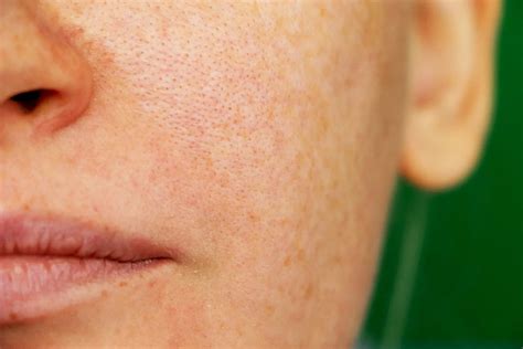 Enlarged Pores Treatments What Are The Best Treatments Health Caffe