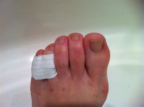 What To Do With A Broken Pinky Toe Things You Didnt Know
