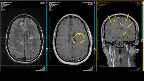 Most people are diagnosed between the tests to help confirm a multiple sclerosis diagnosis. ADC Positive Multiple Sclerosis - Demyelination MRI Case ...