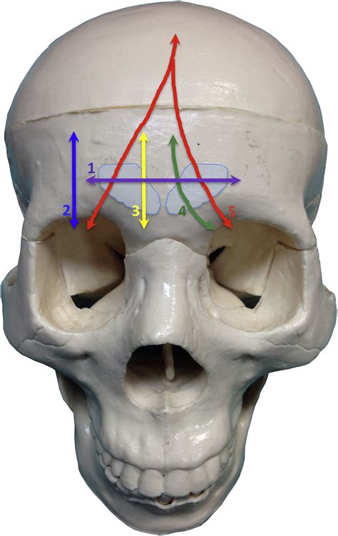 A novel classification of frontal bone fractures: The prognostic ...