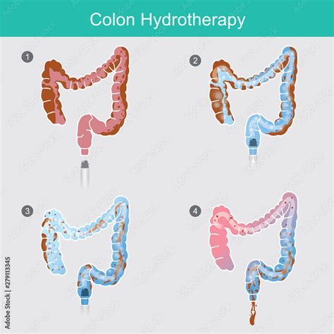 Colon Hydrotherapy 108 Healing House