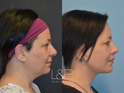 Facelift And Neck Lift Before And After Photos Case 26 Palo Alto And San