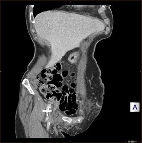 De Garengeots Hernia In An Elderly Woman As A Diagnostic Challenge A Review Of Literature