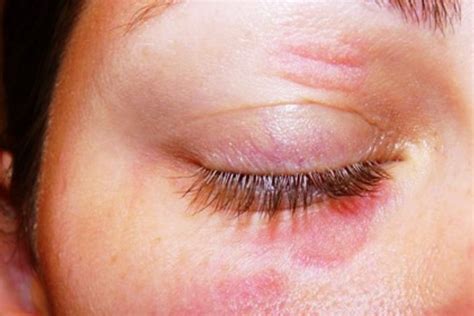 Eyelid Dermatitis Symptoms Causes Treatment The Eye News