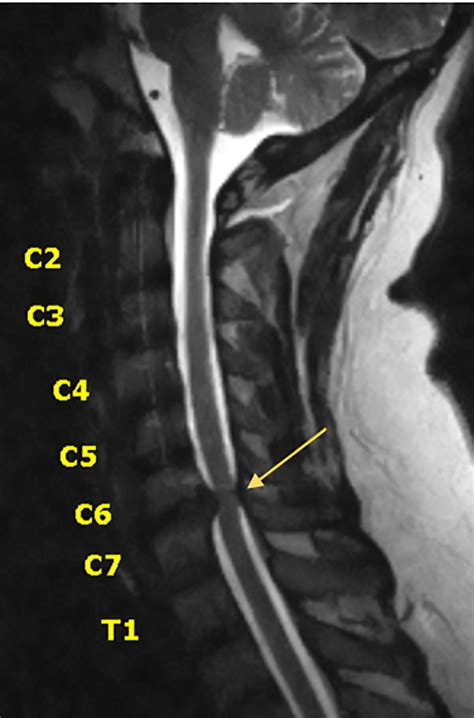 Mri Cervical Spine And Brain Mapayakusa