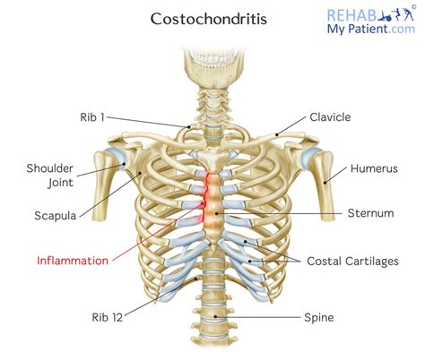 Costochondritis Rehab My Patient Costochondritis Arm Workout