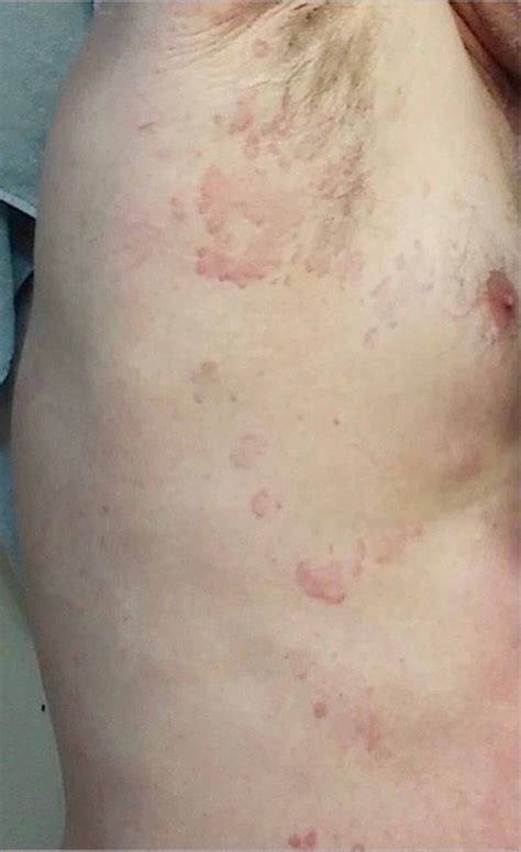 Cureus A Case Of Disseminated Lyme Disease Presenting As Chronic