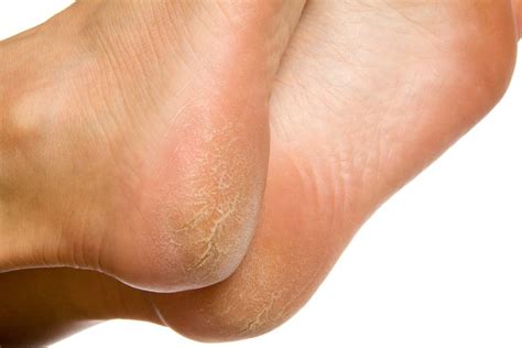 Peeling Feet Symptoms Causes And Treatment