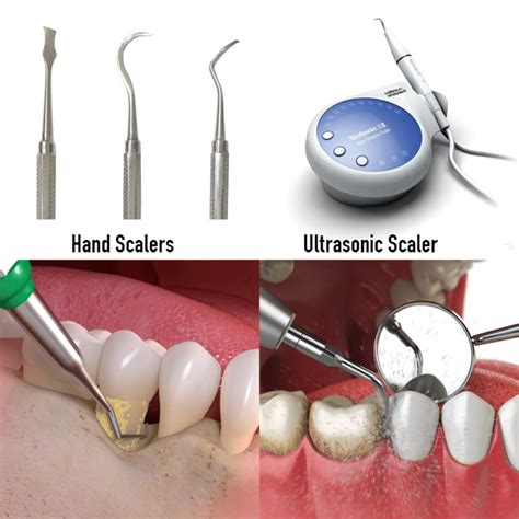 Scaling And Root Planing Treatment In Hyderabad India Fms Dental