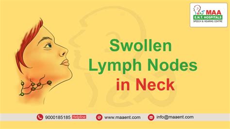 Swollen Lymph Nodes Causes Symptoms And Treatment