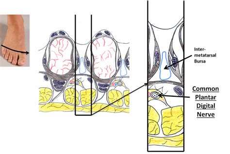 Interdigital Neuroma Ankle Foot And Orthotic Centre