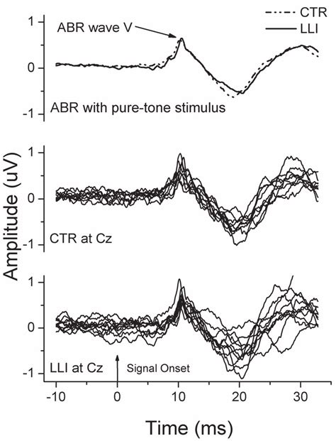 Grand Average Auditory Brainstem Response Abr Waveforms For A 107 Db