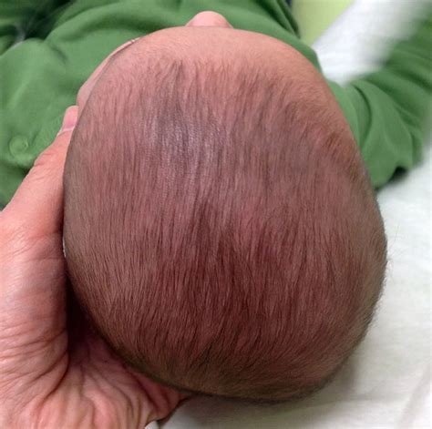 Baby Flat Head Syndrome Plagiocephaly Causes And Treatment
