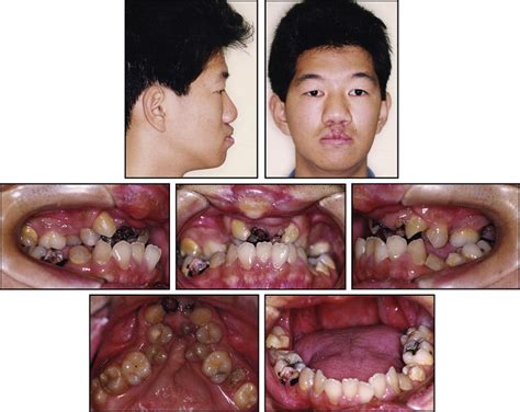 Cleft Lip And Palate Adult