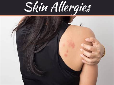 What Are The Different Kinds Of Skin Allergies 99 Health Ideas