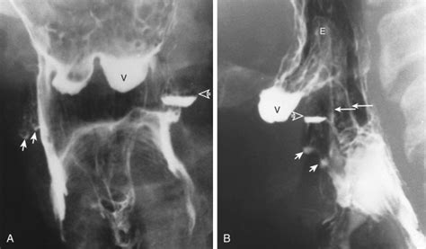 Structural Abnormalities Of The Pharynx Radiology Key