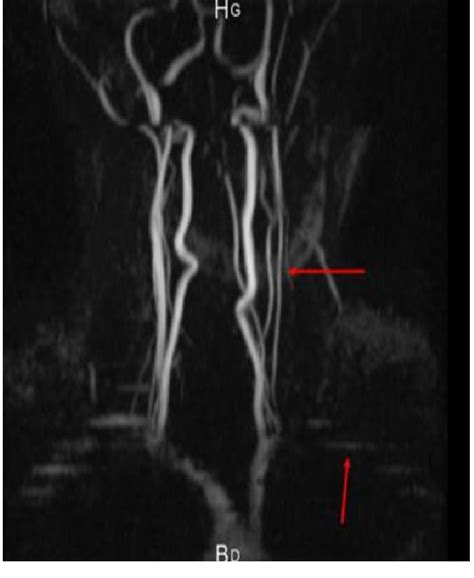 Angio Mri Of The Neck And Head Vessels Showing Left Vertebral Artery