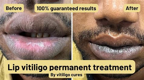 Lip Vitiligo Treatment Pigmentoz Machine Used For Lip Vitiligo Lip