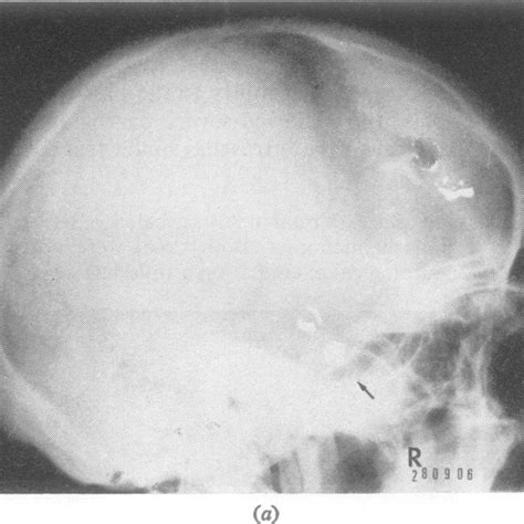Pre Operative Lateral A And Anterior B Skull Radiographs Showing