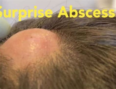 How To Drain An Abscess At Home Archives New Pimple Popping Videos