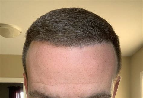 5 month progress update very satisfied with results and clinic hairtransplants