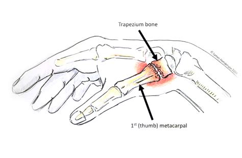 Thumb Base Arthritis James Henderson Specialist Plastic And Hand Surgeon