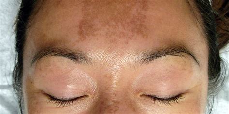 Spots On Face Hormonal Top Secret Skin Tips