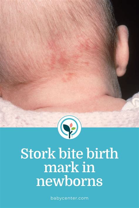 Stork Bite What To Know About Nevus Simplex In Babies In 2022 Baby