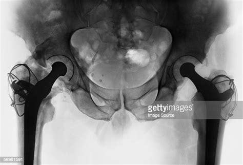 Hip Replacement Xray Photos And Premium High Res Pictures Getty Images