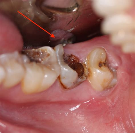 Broken Tooth Oral Facial Surgical Arts Pa