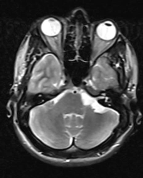 Cerebellopontine Angle Epidermoid Mri Sumers Radiology Blog