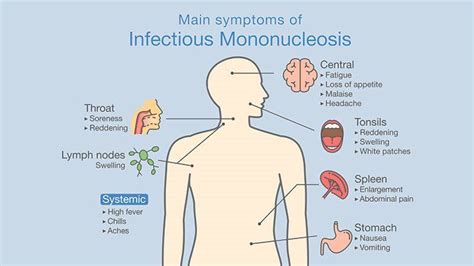 A Brief Recap Of Infectious Mononucleosis In Athletes Sports Medicine