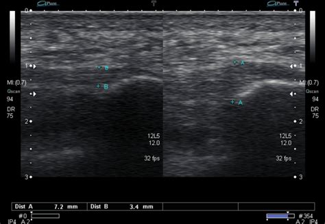 Ultrasound Images Of Plantar Fasciitis Ankle Foot And Orthotic Centre
