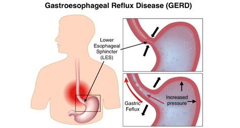 When Acid Reflux Becomes Gastroesophageal Reflux Disease Pediatric