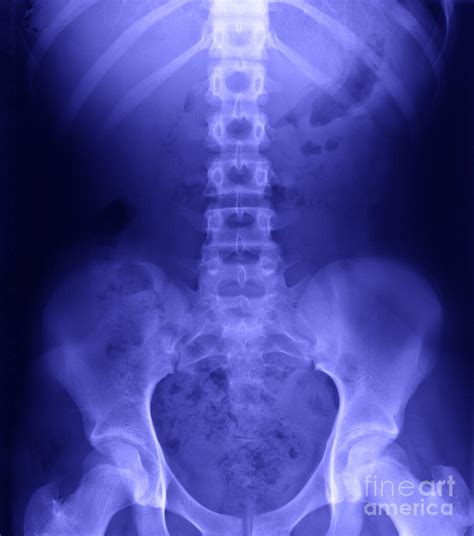 Lumbar And Pelvic X Ray Photograph By Ted Kinsman My Xxx Hot Girl